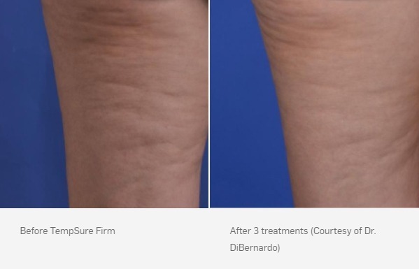 TempSure Firm Before & After | Skin Tightening & Cellulite Reduction