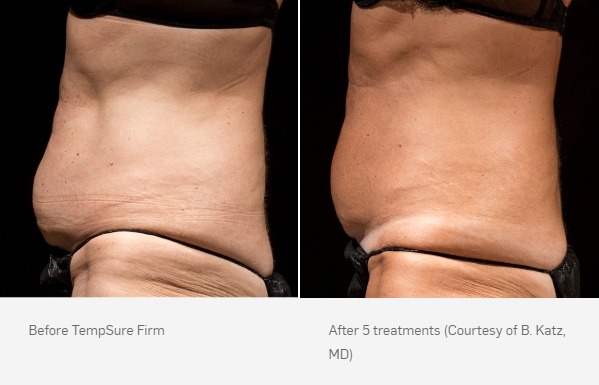 TempSure Firm Before & After | Skin Tightening & Cellulite Reduction
