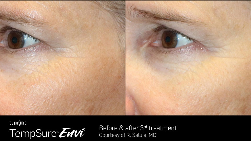 TempSure Envi Before & After | Skin Tightening & Cellulite Reduction