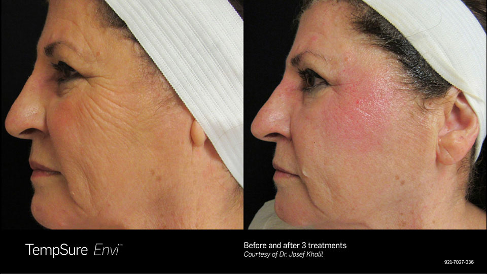 TempSure Envi Before & After | Skin Tightening & Cellulite Reduction